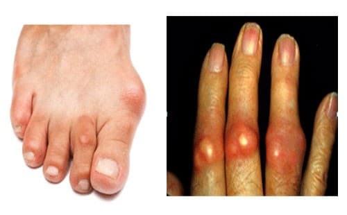 Bệnh gout là một trong những dạng viêm khớp gây đau đớn nhất cho người bệnh. Bệnh biểu hiện rõ rệt qua các cơn đau dài hoặc ngắn với tần suất liên tục.