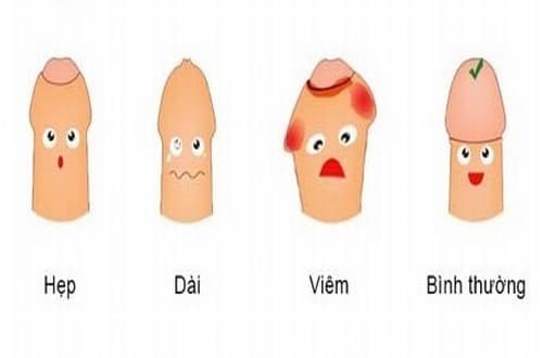 Viêm bao quy đầu là bệnh lý phổ biến ở nam giới