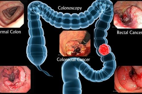 Ung thư đại tràng là bệnh ung thư nguy hiểm thường gặp ở đường tiêu hóa và có tỷ lệ tử vong cao.