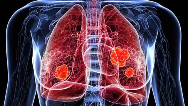 Ngày càng nhiều người trẻ mắc ung thư chỉ vì những thói quen dưới đây