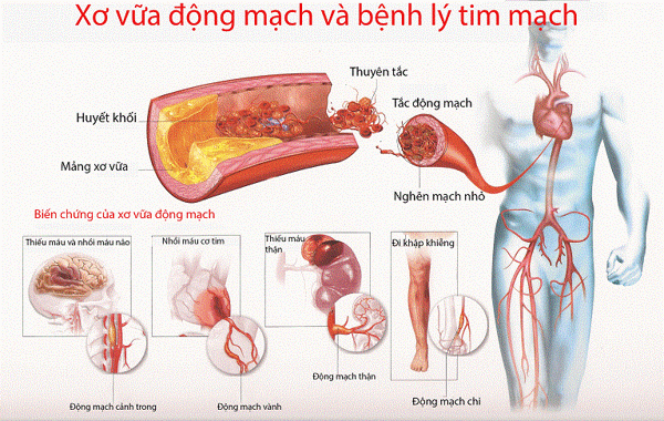 Xơ vữa động mạch là nguyên nhân gây nên các bệnh lý tim mạch