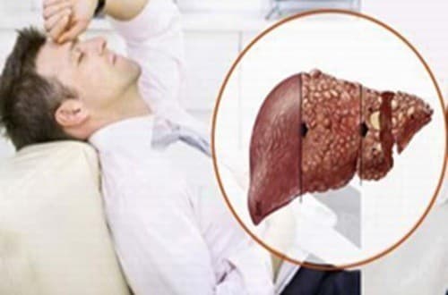 Bệnh lý gan mật khiến bạn mệt mỏi