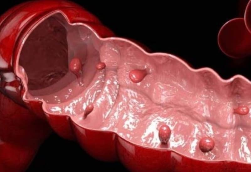 Polyp đại tràng phổ biến hàng đầu trong các loại polyp