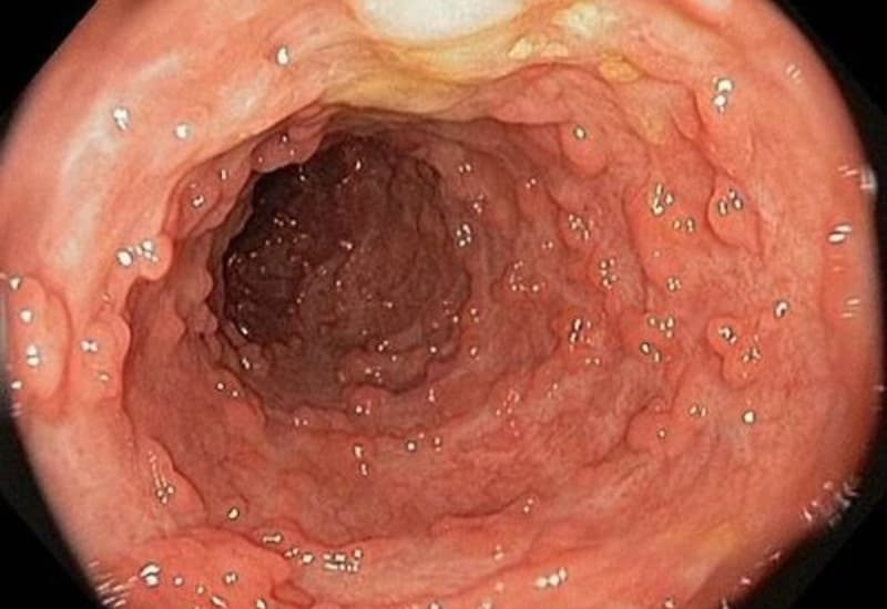 Hội chứng FAP (đa polyp tuyến có tính gia đình) do đột biến gen APC có thể làm xuất hiện nhiều polyp ở đại tràng