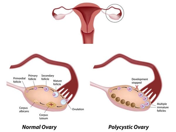 Sự thay đổi nội tiết trong cơ thể khiến chị em dễ mắc hội chứng buồng trứng đa nang