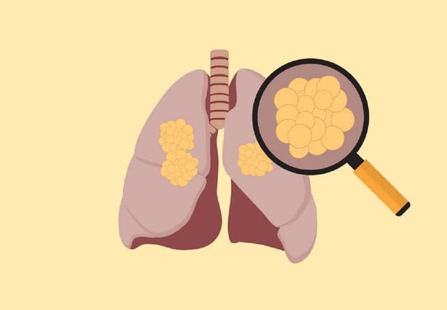 Tìm hiểu các loại ung thư phổi
