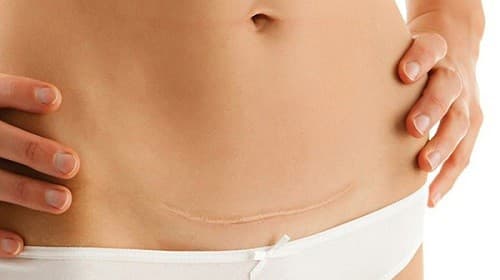 Chăm sóc vết mổ đẻ thế nào?những cơn đau nhức và khó chịu