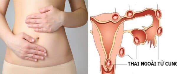 Đau bụng dưới còn có thể do mang thai ngoài tử cung hoặc u nang buồng trứng