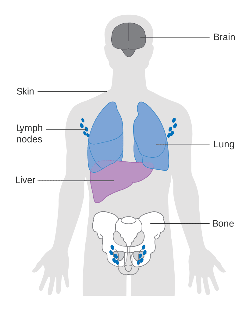 Ung thư giai đoạn cuối có khả năng di căn đến nhiều bộ phận ở xa như gan, phổi, xương...
