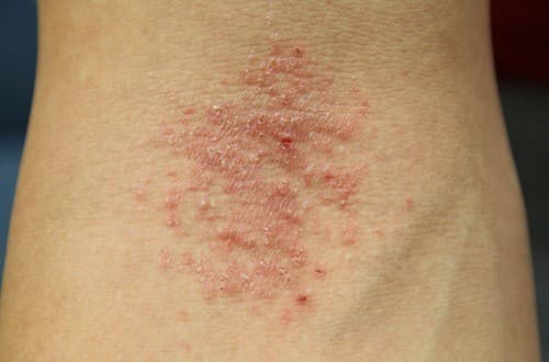 Bệnh eczema cần được điều trị đúng cách