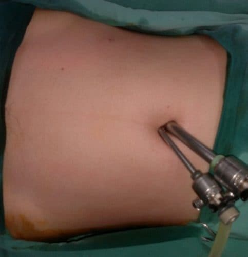 Những rủi ro của mổ ruột thừa thường ít khi xảy ra và không nghiêm trọng bằng việc không điều trị viêm ruột thừa.