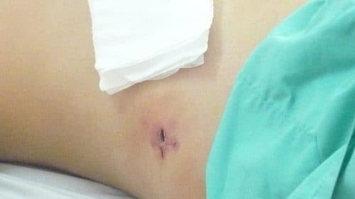 Thông thường nếu không có biến chứng, sau mổ từ 4-6 tuần, bạn có thể trở lại với cuộc sống sinh hoạt, học tập, làm việc bình thường.