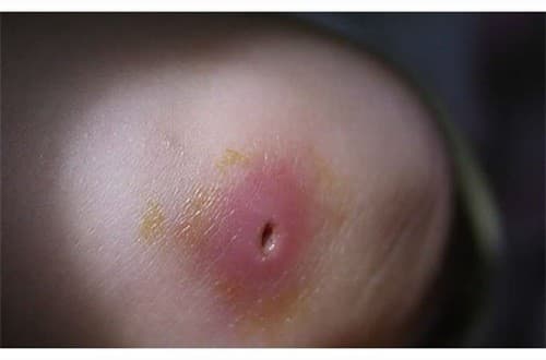 Tình trạng mụn đầu đinh cần được xử trí đúng cách