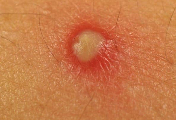 Mụn mủ là một loại mụn rất rất nguy hiểm cho da mặt vì gây viêm và có thể dẫn đến biến chứng nếu người bệnh chủ quan và không chữa trị.