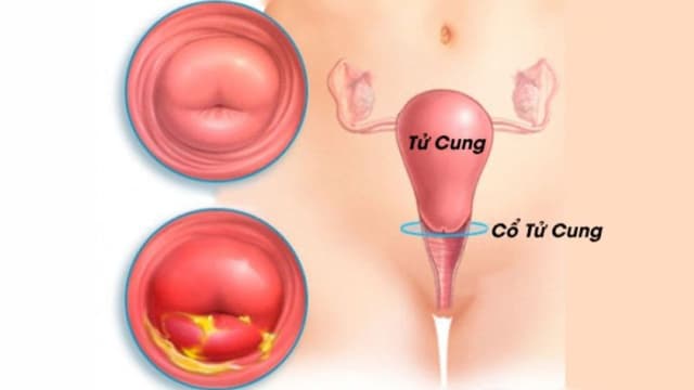 Nguyên nhân gây viêm cổ tử cung