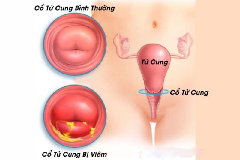 Các bệnh nhiễm trùng đường tình dục có thể gây viêm cổ tử cung