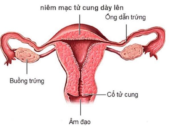 Niêm nạc tử cung là khái niệm dùng để chỉ lớp mỏng bao bọc toàn bộ bề mặt ở phía bên trong tử cung.