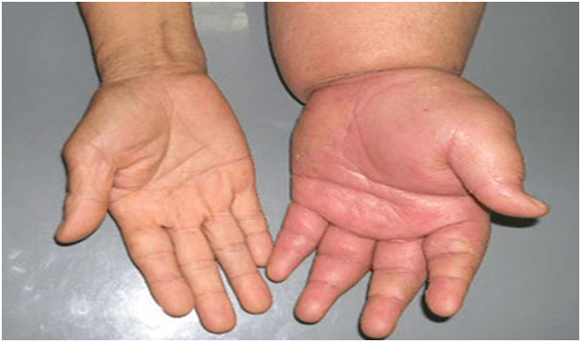 Phù chân tay là dấu hiệu cảnh báo suy thận