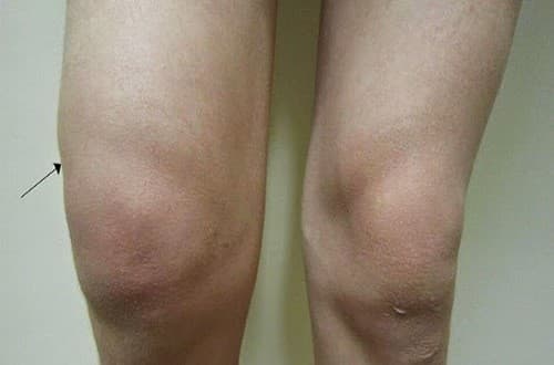 Triệu chứng cảnh báo tràn dịch khớp gối