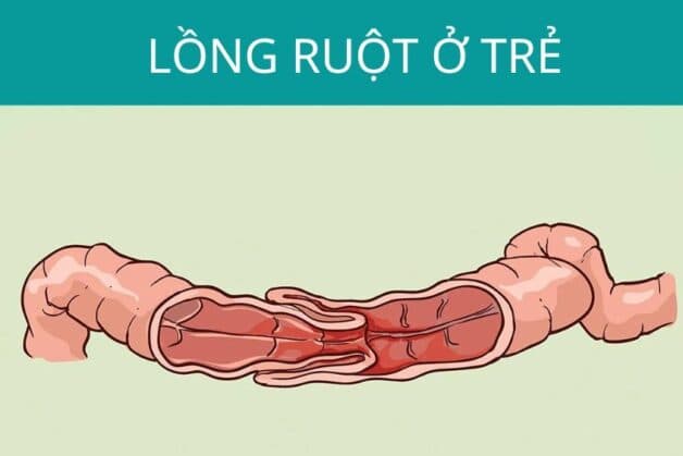 Kiết lỵ có thể khiến trẻ bị lồng ruột