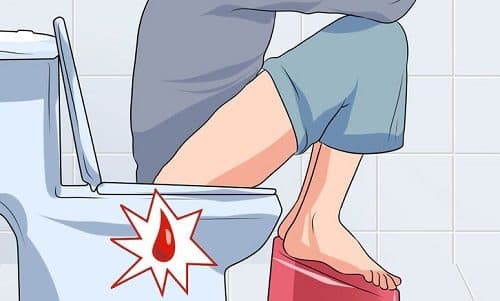 Người bệnh bị polyp hậu môn sẽ có triệu chứng đi ngoài ra máu