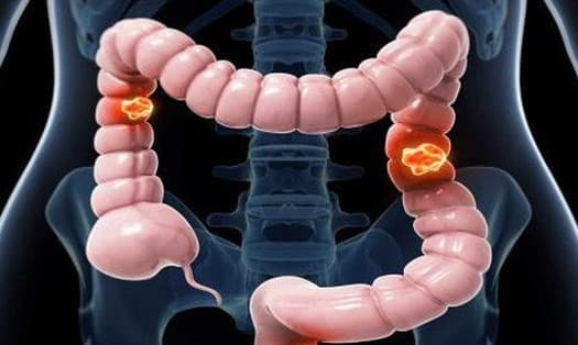 Trung tiện có mùi có thể là dấu hiệu cảnh báo ung thư đại trực tràng