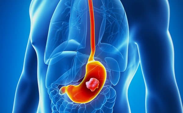 Ung thư dạ dày phổ biến trong các bệnh ung thư đường tiêu hóa ở cả nam giới và nữ giới