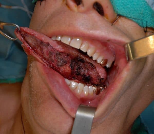 Bệnh nhân ung thư lưỡi sống được bao lâu phụ thuộc vào nhiều yếu tố