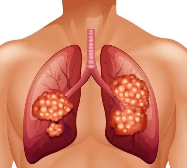 Phân loại bệnh ung thư phổi