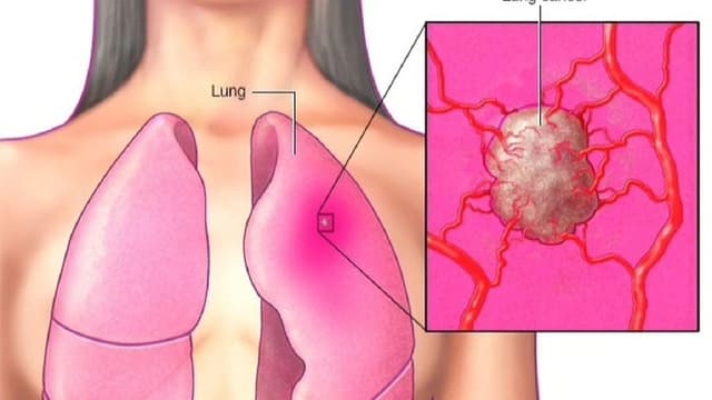 Ung thư phổi giai đoạn 3 đã di căn chưa?