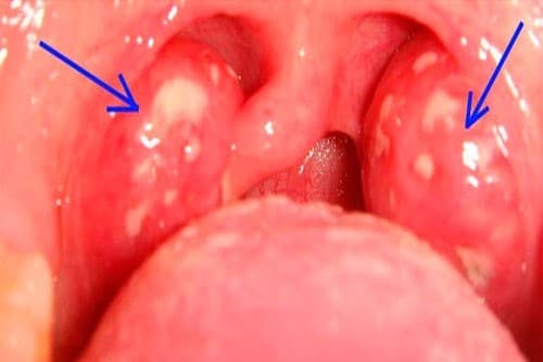 viem-amidan-khi-na-can-cat-1