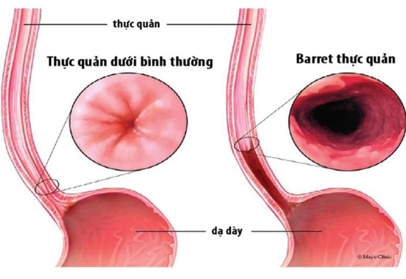 Trào ngược dạ dày thực quản có thể biến chứng thành Barrett thực quản – yếu tố tiền ung thư