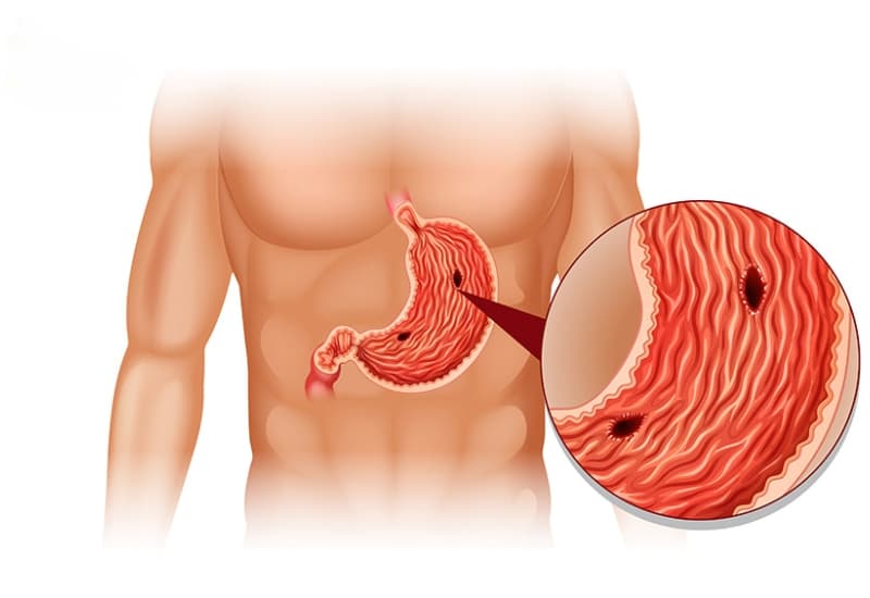 Viêm loét dạ dày là bệnh lý đường tiêu hóa phổ biến