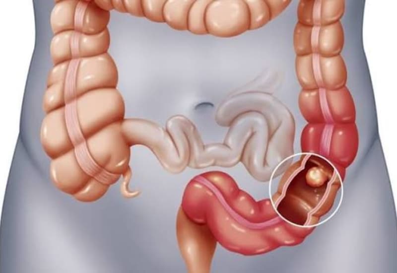 Polyp đại tràng cần được điều trị sớm để ngăn ngừa biến chứng nguy hiểm