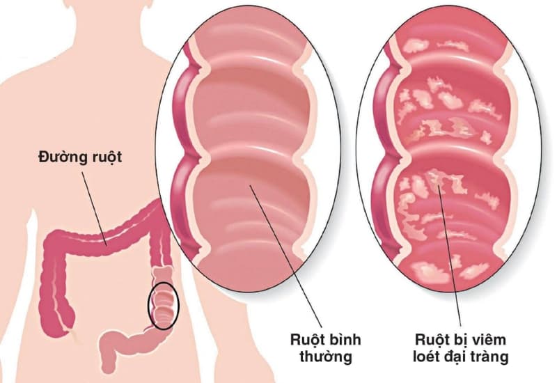 Viêm đại tràng, viêm loét đại tràng… là những bệnh ở đại tràng thường gặp