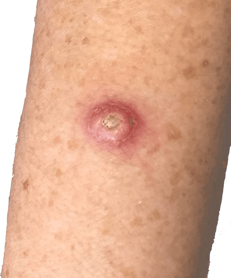 Nhận biết 6 loại ung thư da và triệu chứng mỗi loại