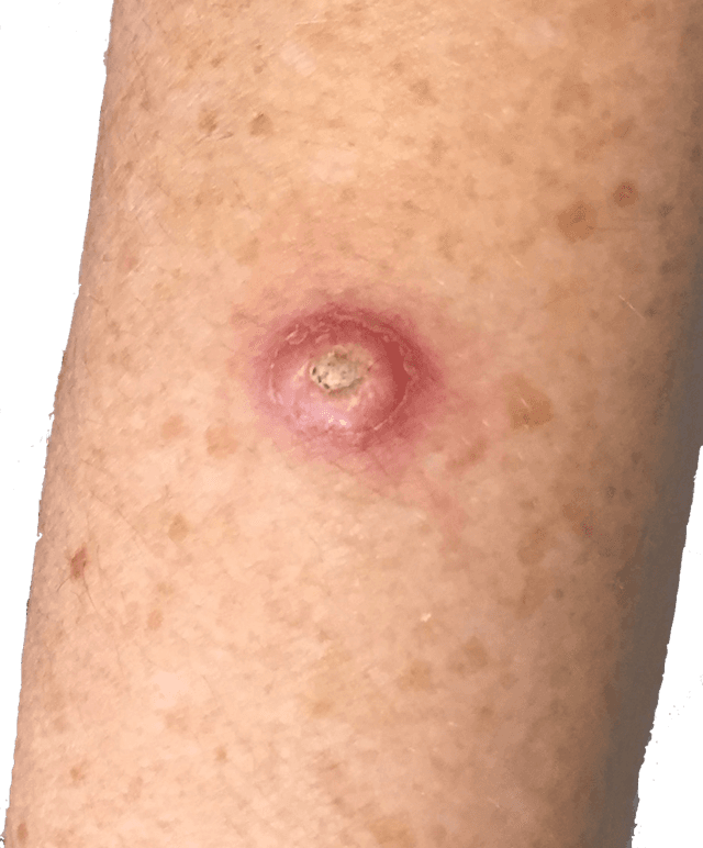 Nhận biết 6 loại ung thư da và triệu chứng của từng loại