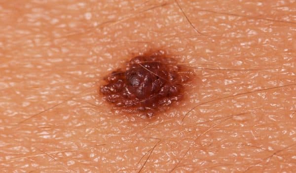 Dấu hiệu ung thư da hắc tố