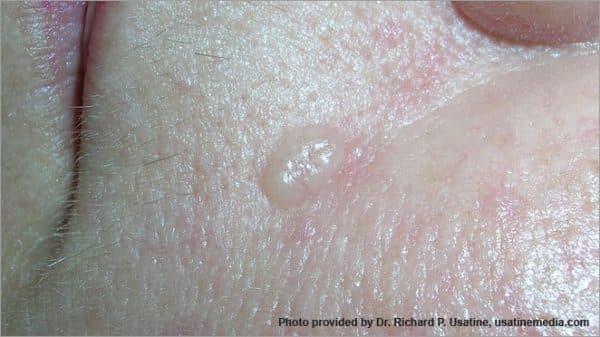 Dấu hiệu ung thư da tế bào đáy