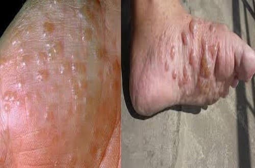 Chàm tổ đỉa cần được phát hiện sớm và điều trị hiệu quả