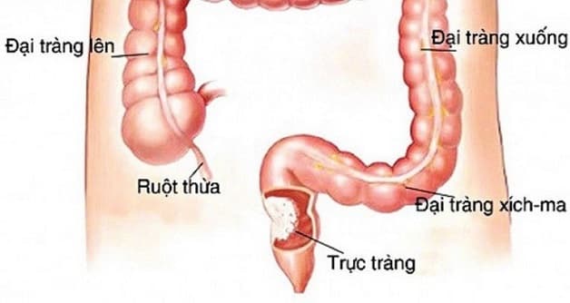 nguyên nhân gây ra bệnh đại tràng là gì