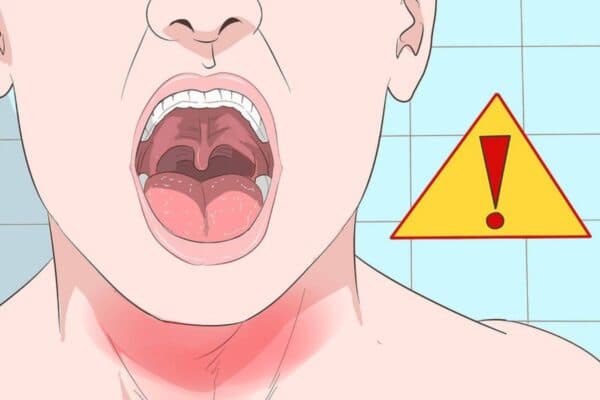 Viêm họng cấp tính không được điều trị kịp thời có thể tiến triển thành mạn tính