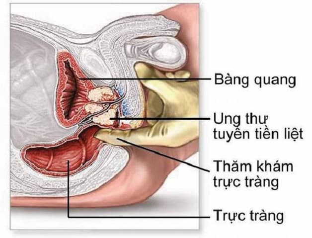 Khám trực tràng