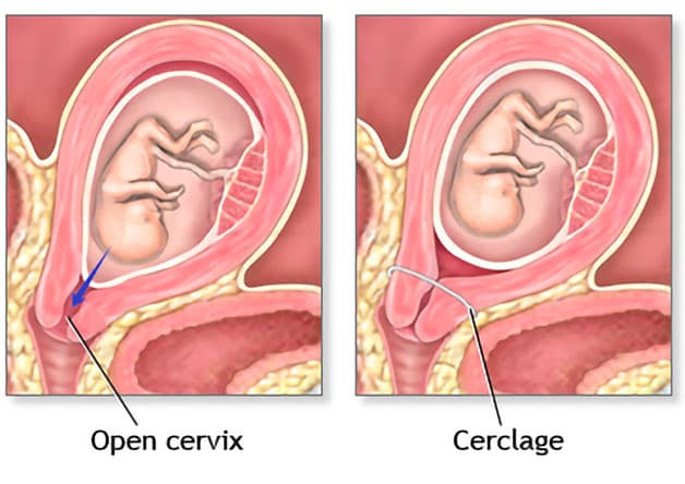 Khâu vòng cổ tử cung là thủ thuật khâu một đường vòng tròn quanh cổ tử cung để thu hẹp lỗ trong cổ tử cung, bảo vệ an toàn cho thai nhi trường hợp mẹ bị hở eo tử cung