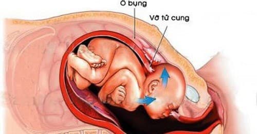 Phẫu thuật bảo tồn tử cung do vỡ tử cung là rất cần thiết.