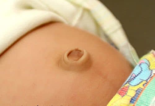 Thoát vị rốn có nguy hiểm không là quan tâm của rất nhiều người.