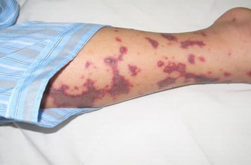 Triệu chứng nguy hiểm của viêm màng não mô cầu