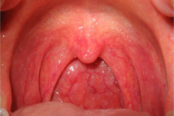 Nhiễm trùng niêm mạc họng dẫn tới tình trạng viêm họng hạt