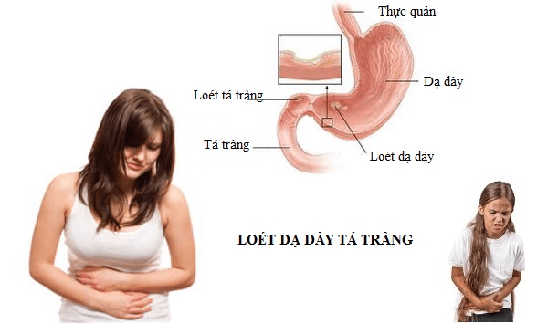 Viêm loét dạ dày tá tràng sẽ gây ra các cơn đau thượng vị, kèm theo buồn nôn và nôn