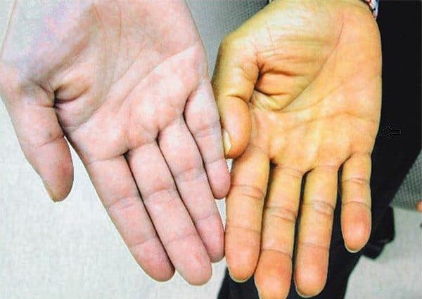 Vàng da là một trong những biểu hiện ung thư gan thường gặp